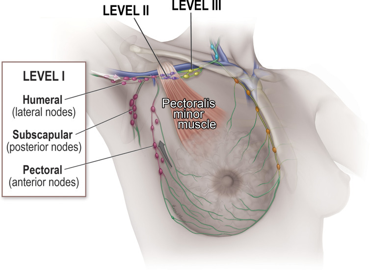 Axillary nodal anatomy and lymphatic drainage. The relationship to the pectoralis minor muscle defines the three anatomic levels of lymph nodes within the axilla. Initial lymphatic drainage of the breast (gray arrow) is predominantly to the level I pectoral group, while initial lymphatic drainage of the upper extremity (white arrow) is predominantly to the level I humeral group.