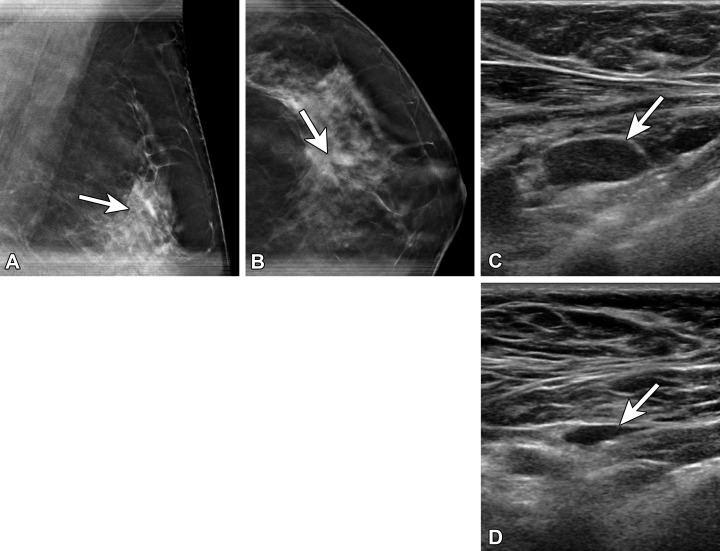 Atypical lobular hyperplasia and radial scar in a 57-year-old woman recalled from screening for an abnormality in the left breast 6 days after receiving the second dose of the Pfizer-BioNTech SARS-CoV-2 vaccine in the left arm. (A, B) MLO (A) and craniocaudal (B) spot-compression tomosynthesis images show architectural distortion (arrow) at the 1-o’clock position. There was no US correlate for the architectural distortion. (C, D) US images of the axilla show a type 6 lymph node (arrow in C), which decreased in size at 8-week follow-up (arrow in D). Stereotactic biopsy of the distortion yielded atypical ductal hyperplasia, while excision yielded atypical lobular hyperplasia and radial scar.