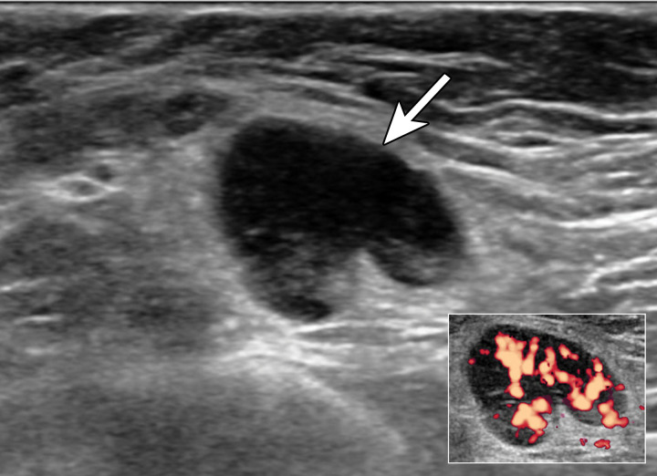 Type 5 lymph node in a 63-year-old BRCA2 mutation carrier with a palpable lump in the left axilla 9 days after receiving the first dose of the Moderna SARS-CoV-2 vaccine in the left arm. In 2006, she underwent left mastectomy for invasive ductal carcinoma. US image shows a type 5 lymph node (arrow), which has associated hyperemia on a power Doppler image (inset) (BI-RADS 4). US-guided core biopsy yielded reactive follicular hyperplasia.