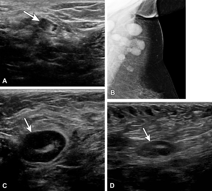 Vaccine-related lymphadenopathy in a 57-year-old man who presented for evaluation of the left axilla after surgical resection of melanoma along his back and positive axillary sentinel lymph node biopsy (SLNB). US image several weeks after an influenza vaccination shows a type 5 lymph node with asymmetric nodular cortical thickening (arrow). Results of core needle biopsy were benign, with no evidence of melanoma. (B–D) Vaccine-related lymphadenopathy in a 59-year-old woman who presented for evaluation of left axillary swelling after recently receiving a tetanus, diphtheria, and pertussis (Tdap) vaccination. Mammogram (B) shows multiple enlarged lymph nodes superiorly within the axilla. US images (C, D) show a type 5 lymph node with asymmetric nodular cortical thickening (arrow in C), which resolved at 3-month follow-up (arrow in D).