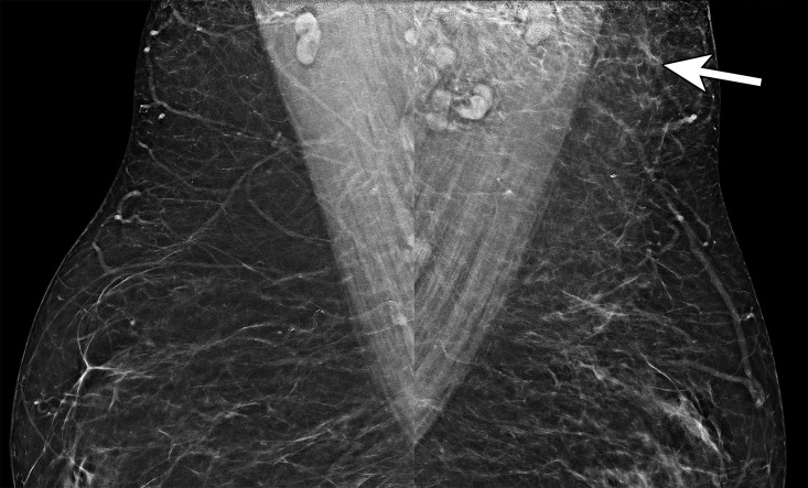 Axillary edema in a 51-year-old woman who underwent screening mammography 3 days after receiving the first dose of the Pfizer-BioNTech SARS-CoV-2 vaccine in the left arm. Bilateral MLO mammograms show asymmetric soft-tissue stranding (arrow) in the left axilla without an associated breast abnormality. This finding is most consistent with axillary edema in the setting of recent vaccination and is benign (BI-RADS 2). Note that the edema is centered around superiorly located lymph nodes, not the inferiorly located lymph nodes.