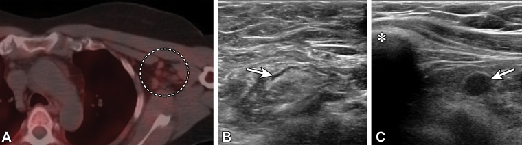 Type 1 axillary lymph node and type 6 infraclavicular lymph node in a 46-year-old woman who underwent bilateral mastectomy in 2014 for invasive ductal carcinoma in the left breast and who presented for SPECT/CT evaluation of a suspected right parathyroid adenoma. Fourteen days earlier, she received the second dose of the Moderna SARS-CoV-2 vaccine in the left arm. (A) Axial image from technetium 99m–sestamibi SPECT/CT shows mild left axillary lymphadenopathy with mild sestamibi uptake (dashed circle). (B, C) US images from short-term follow-up 5 weeks later show a normalized type 1 axillary lymph node (arrow in B) (BI-RADS 2) and a type 6 left infraclavicular lymph node (arrow in C) (BI-RADS 4A). * in C = clavicle. Fine-needle aspiration of the infraclavicular lymph node yielded benign lymphocytes and macrophages.