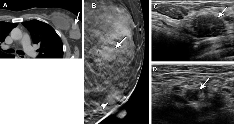 Metastatic carcinoma in a 53-year-old woman with a suspicious mass in the left breast at staging CT, performed after spinal biopsy yielded pathologic findings suggestive of a breast primary. She received the first dose of the Pfizer-BioNTech SARS-CoV-2 vaccine in the left arm 2 days before diagnostic breast imaging. (A) Axial image from staging CT shows the suspicious mass (arrow) in the upper outer left breast. (B) MLO tomosynthesis image shows the corresponding irregular mass (arrow) in the superior left breast. An oval mass (arrowhead) in the subareolar left breast was stable when compared with prior imaging (not shown). (C) US image shows a 1.7-cm mass with irregular margins (arrow) in the left breast at the 2-o’clock position. US-guided core needle biopsy yielded invasive ductal carcinoma. (D) US image of the left axilla shows a corresponding type 6 lymph node (arrow) (BI-RADS 5). Fine-needle aspiration yielded single and clusters of atypical epithelial cells, indicative of metastatic carcinoma.