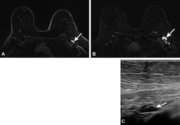 Type 5 lymph node in a 62-year-old woman with human epidermal growth factor receptor 2 (HER2)–positive invasive ductal carcinoma of the left breast, who presented for MRI evaluation of response to neoadjuvant chemotherapy. Three weeks earlier, she received the third (booster) dose of the Moderna SARS-CoV-2 vaccine in the left arm. (A) Pretreatment axial MR image shows a normal-appearing level 1 lymph node (arrow). (B) Posttreatment axial MR image shows enlargement of the lymph node (arrow). (C) Same-day US image of the left axilla shows a type 5 lymph node (arrow) (BI-RADS 4). US-guided core biopsy yielded lymphoid tissue with lymphocytes and histiocytes, without evidence of metastatic carcinoma.