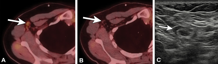 Type 2 axillary lymph node in a 32-year-old woman who underwent neoadjuvant chemotherapy and left mastectomy for invasive ductal carcinoma in 2019 and who presented for restaging with PET/CT. Seven days earlier, she received the first dose of the Pfizer BioNTech SARS-CoV-2 vaccine in the right arm. (A, B) Axial PET/CT images show mild to moderate FDG activity associated with right axillary nodes (arrow in A), new from 4 months earlier (arrow in B). (C) US image of the right axilla 2 months later shows a type 2 axillary lymph node (arrow) (BI-RADS 2).