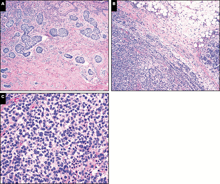 Metastatic Basal Cell Carcinoma Molecular Ancillary Testing And Reappraisal Of Histopathology 8059