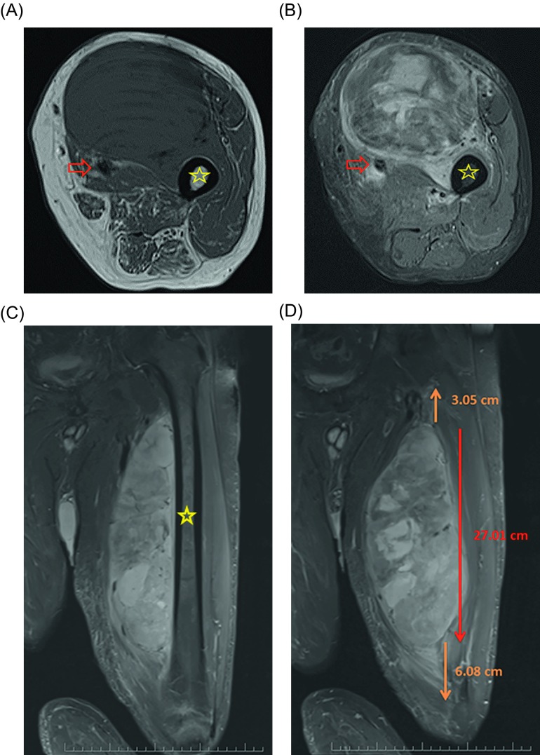 Management of soft-tissue sarcomas; treatment strategies, staging, and ...