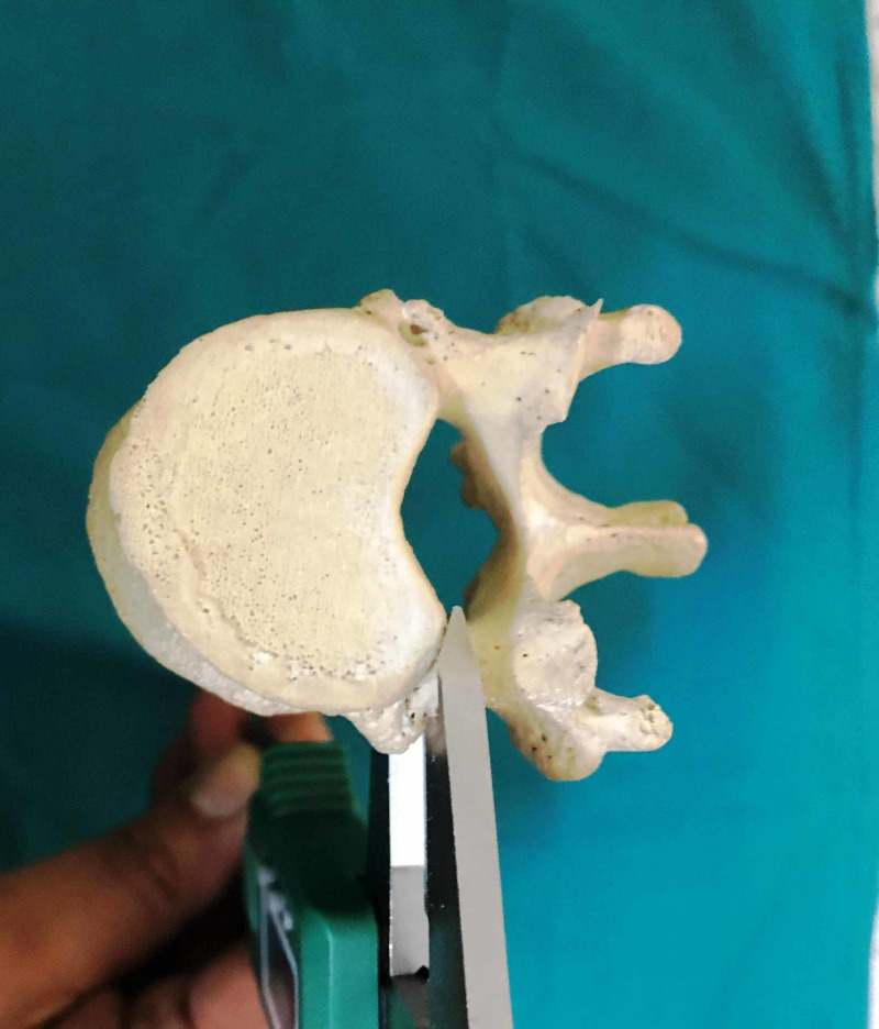 Thoracic Pedicle Morphometry of Dry Vertebral Columns in Relation to ...