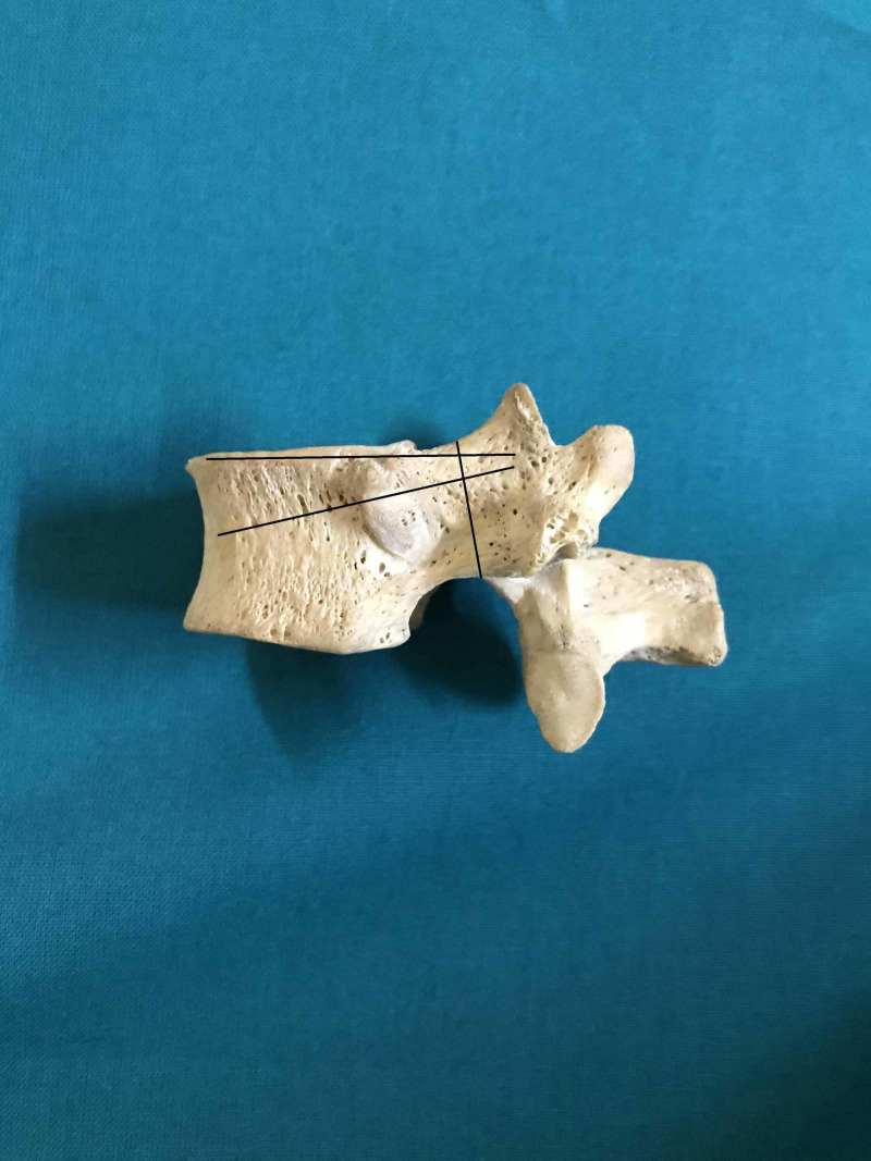 Thoracic Pedicle Morphometry of Dry Vertebral Columns in Relation to ...