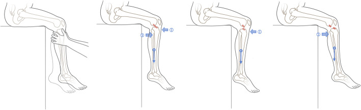 A Modified Anterior Drawer Test For Anterior Cruciate Ligament Ruptures 