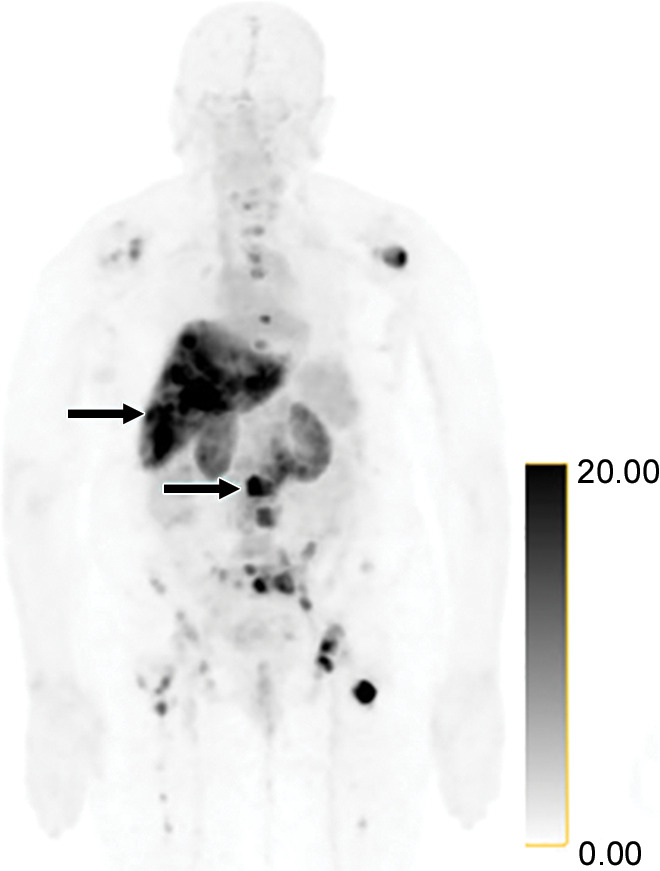 Identification of human epidermal growth factor receptor 2 (HER2)-positive metastases in a 66-year-old woman with HER2-negative primary breast cancer by using HER2-targeted zirconium 89 (89Zr)-pertuzumab PET/CT. (a) HER2 immunohistochemistry of the primary breast malignancy at 200× magnification was 1+ (faint staining, arrow), consistent with HER2-negative malignancy. (b) Maximum intensity projection image from research 89Zr-pertuzumab PET/CT demonstrates multiple osseous and hepatic foci, suspicious for HER2-positive malignancy (arrows show hepatic [standardized uptake value, 18.1] and osseous [standardized uptake value, 16.5] reference lesions). (c) Axial CT image in patient in prone position acquired from a CT-guided biopsy of an 89Zr-pertuzumab–avid osseous focus. (d) HER2 immunohistochemistry at 200× magnification of the biopsied lesion was 2+ (moderate staining, arrow); 2+ HER2 immunohistochemistry is considered equivocal and thus HER2 fluorescence in situ hybridization (FISH) was performed. (e) HE (CEP17) copy number 3.07, and HER2/CEP17 ratio of 3.0, consistent with HER2-positive disease. Given the new diagnosis of HER2-positive metastases, the woman began treatment with docetaxel, trastuzumab, and pertuzumab. (f) Maximum intensity projection image from fluorodeoxyglucose PET/CT performed before initiation of therapy and (g) after 2 months of therapy demonstrate a substantial partial response (arrows in f and g indicate hepatic [standardized uptake value, 4.5 before therapy, standardized uptake value equal to background after therapy] and osseous [standardized uptake value, 8.4 before therapy, standardized uptake value equal to background after therapy] reference lesions).