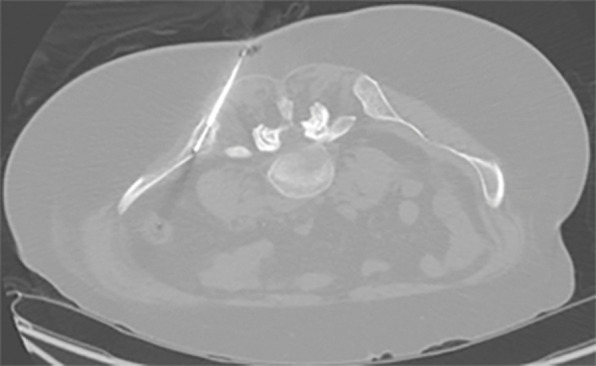 Identification of human epidermal growth factor receptor 2 (HER2)-positive metastases in a 66-year-old woman with HER2-negative primary breast cancer by using HER2-targeted zirconium 89 (89Zr)-pertuzumab PET/CT. (a) HER2 immunohistochemistry of the primary breast malignancy at 200× magnification was 1+ (faint staining, arrow), consistent with HER2-negative malignancy. (b) Maximum intensity projection image from research 89Zr-pertuzumab PET/CT demonstrates multiple osseous and hepatic foci, suspicious for HER2-positive malignancy (arrows show hepatic [standardized uptake value, 18.1] and osseous [standardized uptake value, 16.5] reference lesions). (c) Axial CT image in patient in prone position acquired from a CT-guided biopsy of an 89Zr-pertuzumab–avid osseous focus. (d) HER2 immunohistochemistry at 200× magnification of the biopsied lesion was 2+ (moderate staining, arrow); 2+ HER2 immunohistochemistry is considered equivocal and thus HER2 fluorescence in situ hybridization (FISH) was performed. (e) HE (CEP17) copy number 3.07, and HER2/CEP17 ratio of 3.0, consistent with HER2-positive disease. Given the new diagnosis of HER2-positive metastases, the woman began treatment with docetaxel, trastuzumab, and pertuzumab. (f) Maximum intensity projection image from fluorodeoxyglucose PET/CT performed before initiation of therapy and (g) after 2 months of therapy demonstrate a substantial partial response (arrows in f and g indicate hepatic [standardized uptake value, 4.5 before therapy, standardized uptake value equal to background after therapy] and osseous [standardized uptake value, 8.4 before therapy, standardized uptake value equal to background after therapy] reference lesions).