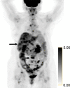 Identification of human epidermal growth factor receptor 2 (HER2)-positive metastases in a 66-year-old woman with HER2-negative primary breast cancer by using HER2-targeted zirconium 89 (89Zr)-pertuzumab PET/CT. (a) HER2 immunohistochemistry of the primary breast malignancy at 200× magnification was 1+ (faint staining, arrow), consistent with HER2-negative malignancy. (b) Maximum intensity projection image from research 89Zr-pertuzumab PET/CT demonstrates multiple osseous and hepatic foci, suspicious for HER2-positive malignancy (arrows show hepatic [standardized uptake value, 18.1] and osseous [standardized uptake value, 16.5] reference lesions). (c) Axial CT image in patient in prone position acquired from a CT-guided biopsy of an 89Zr-pertuzumab–avid osseous focus. (d) HER2 immunohistochemistry at 200× magnification of the biopsied lesion was 2+ (moderate staining, arrow); 2+ HER2 immunohistochemistry is considered equivocal and thus HER2 fluorescence in situ hybridization (FISH) was performed. (e) HE (CEP17) copy number 3.07, and HER2/CEP17 ratio of 3.0, consistent with HER2-positive disease. Given the new diagnosis of HER2-positive metastases, the woman began treatment with docetaxel, trastuzumab, and pertuzumab. (f) Maximum intensity projection image from fluorodeoxyglucose PET/CT performed before initiation of therapy and (g) after 2 months of therapy demonstrate a substantial partial response (arrows in f and g indicate hepatic [standardized uptake value, 4.5 before therapy, standardized uptake value equal to background after therapy] and osseous [standardized uptake value, 8.4 before therapy, standardized uptake value equal to background after therapy] reference lesions).