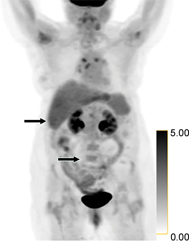 Identification of human epidermal growth factor receptor 2 (HER2)-positive metastases in a 66-year-old woman with HER2-negative primary breast cancer by using HER2-targeted zirconium 89 (89Zr)-pertuzumab PET/CT. (a) HER2 immunohistochemistry of the primary breast malignancy at 200× magnification was 1+ (faint staining, arrow), consistent with HER2-negative malignancy. (b) Maximum intensity projection image from research 89Zr-pertuzumab PET/CT demonstrates multiple osseous and hepatic foci, suspicious for HER2-positive malignancy (arrows show hepatic [standardized uptake value, 18.1] and osseous [standardized uptake value, 16.5] reference lesions). (c) Axial CT image in patient in prone position acquired from a CT-guided biopsy of an 89Zr-pertuzumab–avid osseous focus. (d) HER2 immunohistochemistry at 200× magnification of the biopsied lesion was 2+ (moderate staining, arrow); 2+ HER2 immunohistochemistry is considered equivocal and thus HER2 fluorescence in situ hybridization (FISH) was performed. (e) HE (CEP17) copy number 3.07, and HER2/CEP17 ratio of 3.0, consistent with HER2-positive disease. Given the new diagnosis of HER2-positive metastases, the woman began treatment with docetaxel, trastuzumab, and pertuzumab. (f) Maximum intensity projection image from fluorodeoxyglucose PET/CT performed before initiation of therapy and (g) after 2 months of therapy demonstrate a substantial partial response (arrows in f and g indicate hepatic [standardized uptake value, 4.5 before therapy, standardized uptake value equal to background after therapy] and osseous [standardized uptake value, 8.4 before therapy, standardized uptake value equal to background after therapy] reference lesions).