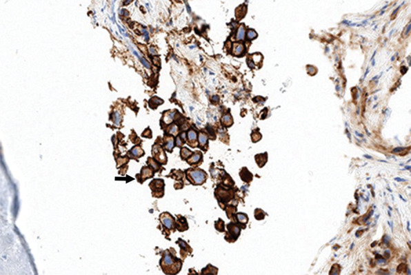 Identification of human epidermal growth factor receptor 2 (HER2)-positive metastases in a 66-year-old woman with HER2-negative primary breast cancer by using HER2-targeted zirconium 89 (89Zr)-pertuzumab PET/CT. (a) HER2 immunohistochemistry of the primary breast malignancy at 200× magnification was 1+ (faint staining, arrow), consistent with HER2-negative malignancy. (b) Maximum intensity projection image from research 89Zr-pertuzumab PET/CT demonstrates multiple osseous and hepatic foci, suspicious for HER2-positive malignancy (arrows show hepatic [standardized uptake value, 18.1] and osseous [standardized uptake value, 16.5] reference lesions). (c) Axial CT image in patient in prone position acquired from a CT-guided biopsy of an 89Zr-pertuzumab–avid osseous focus. (d) HER2 immunohistochemistry at 200× magnification of the biopsied lesion was 2+ (moderate staining, arrow); 2+ HER2 immunohistochemistry is considered equivocal and thus HER2 fluorescence in situ hybridization (FISH) was performed. (e) HE (CEP17) copy number 3.07, and HER2/CEP17 ratio of 3.0, consistent with HER2-positive disease. Given the new diagnosis of HER2-positive metastases, the woman began treatment with docetaxel, trastuzumab, and pertuzumab. (f) Maximum intensity projection image from fluorodeoxyglucose PET/CT performed before initiation of therapy and (g) after 2 months of therapy demonstrate a substantial partial response (arrows in f and g indicate hepatic [standardized uptake value, 4.5 before therapy, standardized uptake value equal to background after therapy] and osseous [standardized uptake value, 8.4 before therapy, standardized uptake value equal to background after therapy] reference lesions).