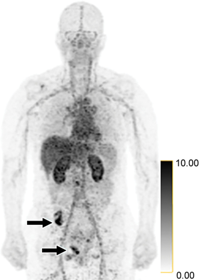 False-positive findings at zirconium 89 (89Zr)-pertuzumab PET/CT in a 47-year-old woman with human epidermal growth factor receptor 2 (HER2)-negative primary breast cancer. HER2 immunohistochemistry of the primary breast malignancy was 1+ (not shown), consistent with HER2-negative malignancy. (a) Maximum intensity projection image from research 89Zr-pertuzumab PET/CT demonstrates osseous foci in the right pelvis (arrows on osseous lesions; standardized uptake values, 13.8 and 11.9), suspicious for HER2-positive malignancy. (b) Axial CT and fused 89Zr-pertuzumab PET/CT images acquired from a PET/CT-guided biopsy of an 89Zr-pertuzumab–avid osseous focus (arrow). Pathologic analysis demonstrated HER2 immunohistochemistry 2+ and FISH 1.4 (not shown), consistent with HER2-negative disease.