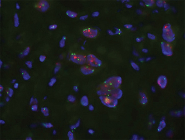 Identification of human epidermal growth factor receptor 2 (HER2)-positive metastases in a 66-year-old woman with HER2-negative primary breast cancer by using HER2-targeted zirconium 89 (89Zr)-pertuzumab PET/CT. (a) HER2 immunohistochemistry of the primary breast malignancy at 200× magnification was 1+ (faint staining, arrow), consistent with HER2-negative malignancy. (b) Maximum intensity projection image from research 89Zr-pertuzumab PET/CT demonstrates multiple osseous and hepatic foci, suspicious for HER2-positive malignancy (arrows show hepatic [standardized uptake value, 18.1] and osseous [standardized uptake value, 16.5] reference lesions). (c) Axial CT image in patient in prone position acquired from a CT-guided biopsy of an 89Zr-pertuzumab–avid osseous focus. (d) HER2 immunohistochemistry at 200× magnification of the biopsied lesion was 2+ (moderate staining, arrow); 2+ HER2 immunohistochemistry is considered equivocal and thus HER2 fluorescence in situ hybridization (FISH) was performed. (e) HE (CEP17) copy number 3.07, and HER2/CEP17 ratio of 3.0, consistent with HER2-positive disease. Given the new diagnosis of HER2-positive metastases, the woman began treatment with docetaxel, trastuzumab, and pertuzumab. (f) Maximum intensity projection image from fluorodeoxyglucose PET/CT performed before initiation of therapy and (g) after 2 months of therapy demonstrate a substantial partial response (arrows in f and g indicate hepatic [standardized uptake value, 4.5 before therapy, standardized uptake value equal to background after therapy] and osseous [standardized uptake value, 8.4 before therapy, standardized uptake value equal to background after therapy] reference lesions).