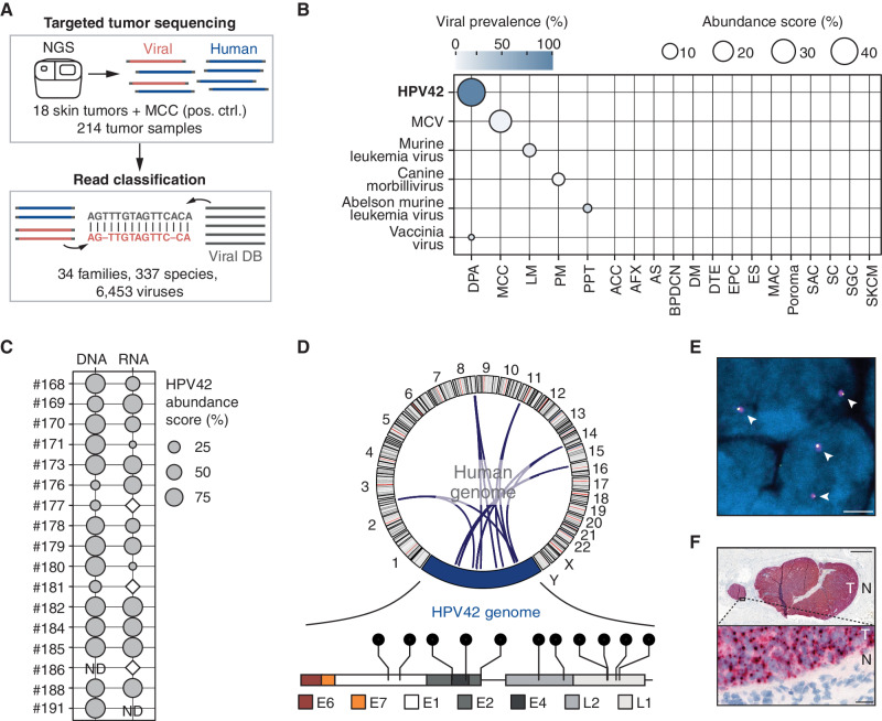 Figure 1. HPV42 is associated with DPA. A, Overview of unbiased screening approach for detection of vertebrate-infecting viruses in targeted next-generation sequencing (NGS) data. Targeted NGS data from 18 skin tumor types and Merkel cell carcinoma (MCC, positive control) were analyzed with the centrifuge metagenomic classifier utilizing a custom viral database (Viral DB). B, Virus abundance score in targeted NGS data of 214 human tumor samples. Detection of HPV42 in 100% (n = 11/11) of DPA samples. DPA, digital papillary adenocarcinoma; MCC, Merkel cell carcinoma; LM, lentigo maligna melanoma; PM, pediatric melanoma; PPT, proliferating pilar cystic tumor; ACC, adenoid cystic carcinoma; AFX, atypical fibroxanthoma; AS, angiosarcoma; BPDCN, blastic plasmacytoid dendritic cell neoplasm; DM, desmoplastic melanoma; DTE, desmoplastic trichoepithelioma; EPC, eccrine porocarcinoma; ES, eccrine spiradenoma; MAC, microcystic adnexal carcinoma; poroma, poroma; SAC, spiradenocarcinoma; SC, sebaceous carcinoma; SGC, sweat gland carcinoma; SKCM, cutaneous melanoma. Viral prevalence: proportion of samples with detected virus in any given tumor type. Abundance score: mean proportion of detected virus in any given tumor type. C, HPV42 abundance score in a cohort of 17 DPAs after sequence capture to DNA and RNA of 6,453 viruses. White diamond: HPV42 detected but below an abundance of 1%. ND: not determined. D, Top, Circos plot depicting HPV42-human genome breakpoints. Each arch represents one detected breakpoint. Bottom, lollipop presentation of integration breakpoints in the HPV42 genome. Each lollipop represents one breakpoint (Supplementary Table S4). E, FISH signal of HPV42 genome (magenta) and human genome integration site adjacent locus (yellow) in DPA nuclei (blue). White arrows indicate fusion signals. Scale bar, 2.5 μm. Individual channels and quantifications in Supplementary Fig. S4. F, (Top), RNA in situ hybridization (ISH) staining for expression of early region HPV42 mRNA in lung metastasis of a DPA tumor (T) and the surrounding normal (N) tissue. Scale bar, 1 mm; (bottom) Inset. Scale bar, 20 μm.