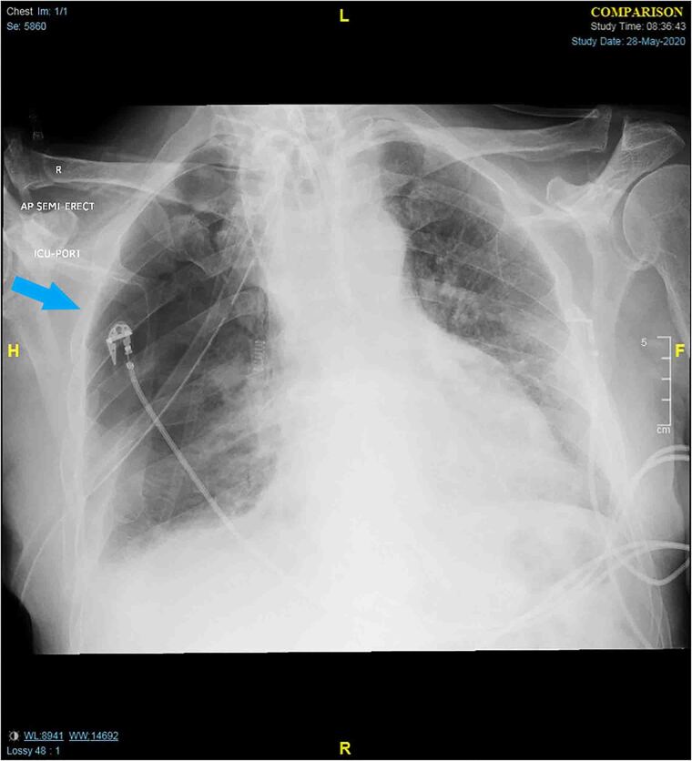 Endobronchial valve use in COVID-19 related pneumothorax and persistent ...