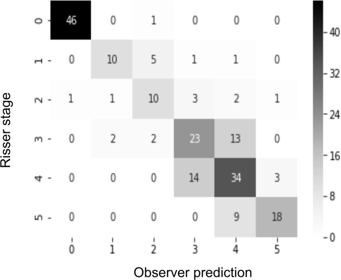 (a) Confusion matrix for the automatic grading method. (b) Confusion matrix for one of the observers. The rows of the matrix show the values indicated by the observer, while the columns show the ground truth. The values on the diagonal of the matrix illustrate the number of samples correctly classified by Risser grade. The values above and below each value of the diagonal show misclassified samples.