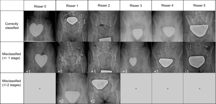 (a) Sample radiographic images graded by the automatic grading method (AGM). First row: Correctly classified. Second row: Misclassified by one grade. Third row: Misclassified by two grades. (b) Sample radiographic images. First row: ground truth (GT). Second row: Risser stage assigned by each observer. Third row: Risser stage assigned by AGM. Fourth row: Original image. Fifth row: Gradient-weighted class activation mapping (Grad-CAM) highlighting the AGM’s most important regions of images. The color map scales from red (most discriminant) to blue (least discriminant).