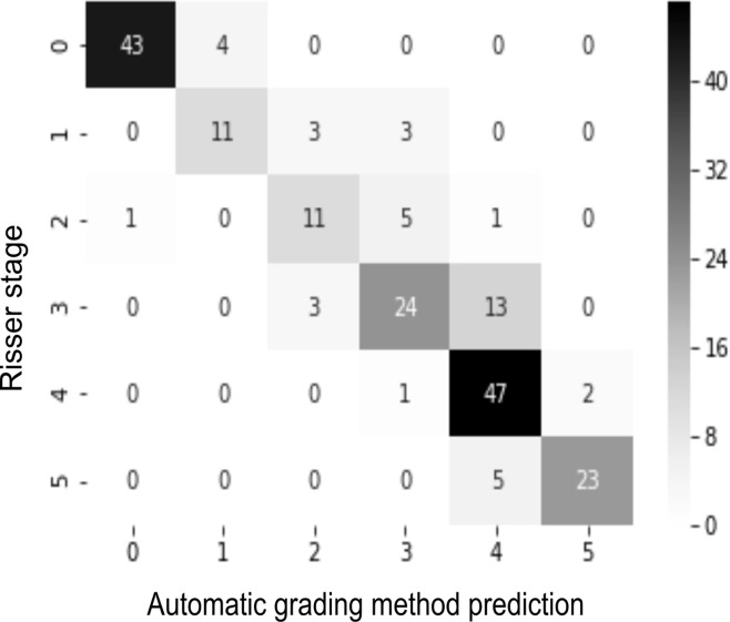 (a) Confusion matrix for the automatic grading method. (b) Confusion matrix for one of the observers. The rows of the matrix show the values indicated by the observer, while the columns show the ground truth. The values on the diagonal of the matrix illustrate the number of samples correctly classified by Risser grade. The values above and below each value of the diagonal show misclassified samples.