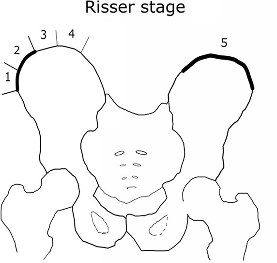 (a) Distribution of the Risser grade in the radiographic database. The expert test set consisted of 200 images to assess rater variability. The holdout set was used to test the model. The training-validation set was used to train and validate the model. (b) Visual illustration of iliac crest progression and corresponding Risser stages.