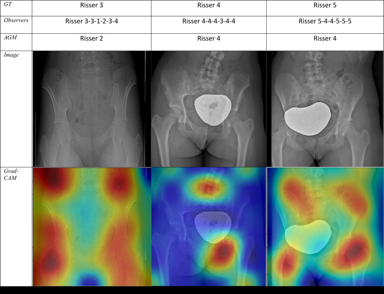 (a) Sample radiographic images graded by the automatic grading method (AGM). First row: Correctly classified. Second row: Misclassified by one grade. Third row: Misclassified by two grades. (b) Sample radiographic images. First row: ground truth (GT). Second row: Risser stage assigned by each observer. Third row: Risser stage assigned by AGM. Fourth row: Original image. Fifth row: Gradient-weighted class activation mapping (Grad-CAM) highlighting the AGM’s most important regions of images. The color map scales from red (most discriminant) to blue (least discriminant).