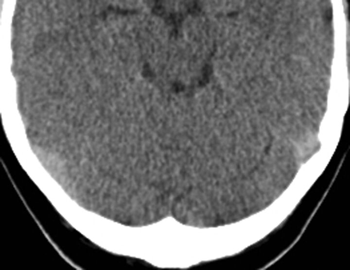 CT Density Measurement and H:H Ratio Are Useful in Diagnosing Acute ...