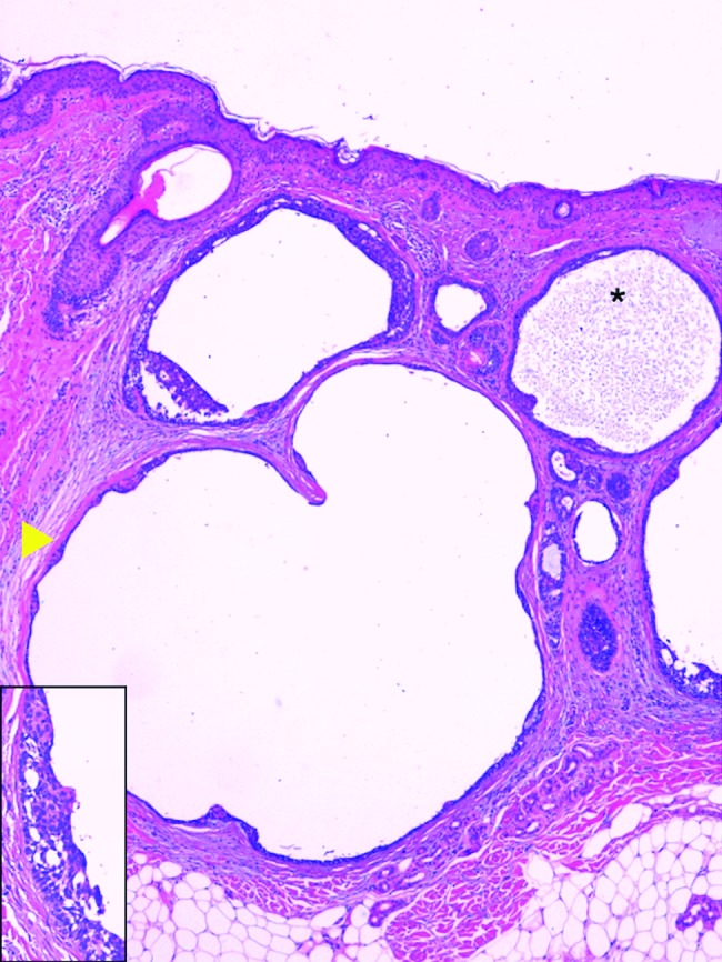 Nodular Cystic Variant Of Basal Cell Carcinoma Perfect Correlation