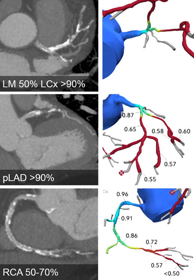 CT angiographic images (left) and FFR CT models (right) show severe three-vessel disease with anatomically and functionally significant obstructive disease of the left main (LM), left anterior descending (LAD), left circumflex (LCx), and right coronary artery (RCA) (white arrowheads). Future developments may result in such patients being triaged straight to coronary artery bypass graft surgery without the need for further testing.