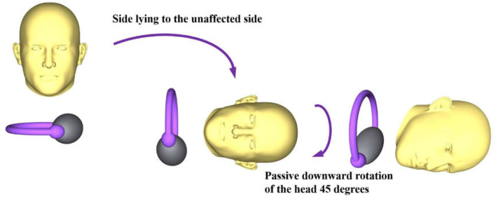 Case Report: New Application of a Gufoni Maneuver Variation for ...