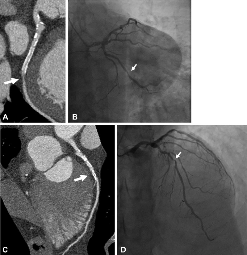 Case example of a 61-year-old man with history of myocardial infarction who was found at UHR-CT to have a severe (≥ 70%) stenosis in a large obtuse marginal branch of the left circumflex artery just distal to (A) a patent stent, which was confirmed at (B) invasive angiography. In addition, there was moderate disease noted by (C) ultra-high-resolution CT in the left main and in the mid left anterior descending artery (50%–70% stenosis), which was underestimated compared with (D) invasive angiography (70% stenosis). Arrow points to corresponding stenoses.