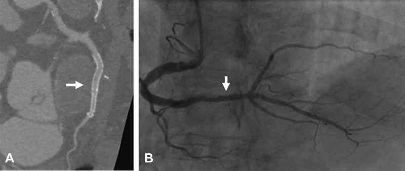 Case example of a 62-year-old man complaining of chest pain who was found to have patent stents in his mid and distal right coronary artery at ultra-high-resolution CT (UHR-CT), displayed in (A) curved multiplanar view, which was confirmed with (B) invasive coronary angiography. Arrow points to the corresponding parts in the vessel by UHR-CT and invasive angiography.