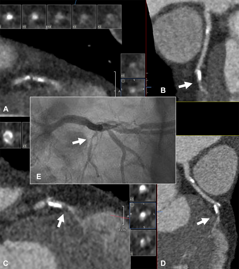 Case example of a 62-year-old man with history of hypertension, severe obesity, hyperlipidemia, and atrial fibrillation presenting with progressive, exertional chest discomfort. He initially underwent coronary angiography using conventional CT technology (320-detector scanner with 0.5-mm detector width, 0.275-msec gantry rotation). His heart rate was less than 50 beats per minute at the time of image acquisition, and tube settings were 120 kV and 740 mA (maximum). (A) Corresponding images of the mid left anterior descending artery are shown using a sharp reconstruction filter (FC05). Note the poorly differentiated lumen borders (arrow) leading to uncertainty about the stenosis severity in the corresponding (B) curved multiplanar reformatted projection. The patient then underwent ultra-high-resolution (UHR) CT within 1 week of the conventional CT using a gantry rotation of 350 msec, 120 kV, and 580 mA (maximum). Recorded heart rate was 61 beats per minute. Images were again reconstructed using a sharp reconstruction kernel (FC05). (C, D) UHR-CT images. Note the sharper lumen borders and clear identification of a severe stenosis (arrow). (E) Corresponding invasive angiogram obtained within 72 hours of the UHR-CT. The arrow points to the stenosis in the small mid distal left anterior descending artery system.