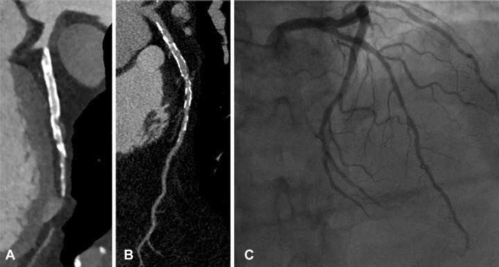 Case example of a 52-year-old man with history of hypertension, familial hyperlipidemia, and a normal nuclear stress test but with a calcium score of 2780. The patient initially underwent conventional CT angiography (CTA) for further assessment. Images were acquired with a dual-source (2 × 128 section) system, 285-msec gantry rotation, 110 kV, 371 mA. Images were reconstructed using 0.75-mm slice thickness and kernel Bv38f\3. (A) Curved planar reformatted projection of the left anterior descending artery (LAD) with conventional CTA along with cross-sectional views. With conventional CT, the LAD was reported to contain 70%–99% stenoses in proximal and mid section and a greater than 95% stenosis in the distal vessel. In contrast, (B) results from blinded ultra-high-resolution CT evaluation suggested heavily calcified LAD and lumen without obstructive disease, which was confirmed with (C) invasive angiography.