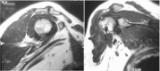 <b>Fig. 5</b>: MRI right shoulder sagittal view showing marked
arthropathic changes and the axial view with
oedema below the acromioclavicular joint with
supraspinatus impingement.