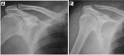 <b>Fig. 4</b>: Preoperative X-ray showing not much
acromioclavicular joint narrowing(A) Postoperative,
distal clavicle resection.(B)
