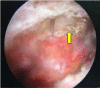 <b>Fig. 6</b>: View from lateral portal of arthroscope: needle
pierced through the acromioclavicular joint. Distal
clavicle resected by using burr.