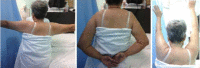 <b>Fig. 3</b>: Patient demonstrating full range of movement of left shoulder without sign of impingement.