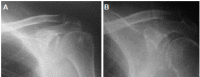 <b>Fig. 1</b>: Preoperative plain radiograph of left shoulder
showing degenerative changes of the
cromioclavicular joint with narrowing of joint
space(A). Postoperative radiograph of the same
patient with distal clavicle resection(B).