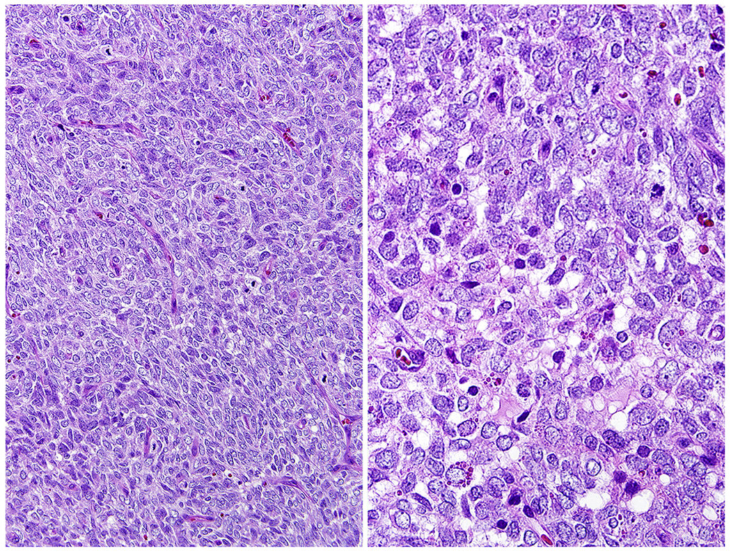 New fusion sarcomas: histopathology and clinical significance of ...