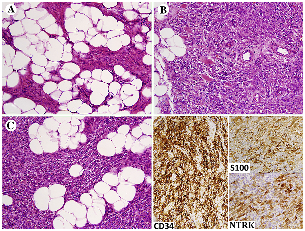 New fusion sarcomas: histopathology and clinical significance of ...