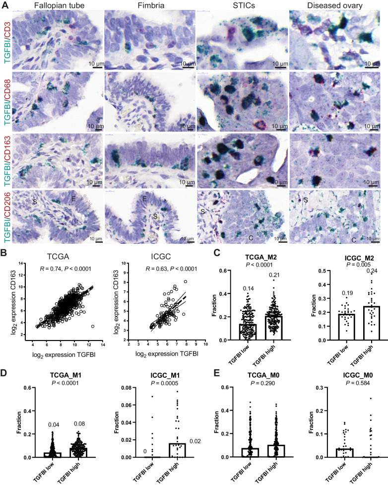 Figure 2. TGFBI is produced by TAMs. A, Dual ISH for TGFBI with either CD3, CD68, CD163, or CD206 in healthy and diseased FT and OV. B, Correlation of CD163 with TGFBI within TCGA and ICGC HGSOC transcriptional datasets. C–E, CIBERSORT fractions of M2, M1, and M0 macrophages in TGFBI low and high patients of TCGA and ICGC dataset. Statistical significance was determined using Student t test. Median values are indicated.