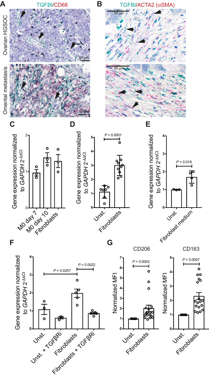 Figure 5. Cross-talk between TGFβ-secreting fibroblasts and macrophages. A, Dual ISH for TGFBI and CD68 in HGSOC in the ovary and omentum. Fibroblast-like cells (black arrows) span the stroma and express TGFBI but not CD68. B, Dual ISH for TGFBI and ACTA2 in HGSOC in the ovary and omentum. Examples of ACTA2-TGFBI are indicated by black arrows. C, TGFBI mRNA expression comparing the basal levels of transcript in unstimulated macrophages (n = 3) and primary omental fibroblasts (n = 3). Statistical significance was determined using one-way ANOVA with Dunnett multiple comparisons test. Nonsignificant, P > 0.05. D, TGFBI mRNA expression of cocultured macrophages with primary fibroblasts. Data shown are mean ± SD. Unstimulated macrophages, n = 7; fibroblasts, n = 10. Statistical significance was determined using one-way ANOVA with Dunnett multiple comparisons test. E, TGFBI mRNA expression by macrophages cultured in 50% fresh culture medium and 50% fibroblast-derived medium. Data shown are mean ± SD. Unstimulated (n = 3) versus fibroblast medium of four different donors (n = 4). Statistical significance was determined using unpaired t test. F, TGFBI mRNA expression of cocultured macrophages with omental fibroblasts in the presence or absence of the selective TGFβRi. Data shown are mean ± SD. n = 3 and n = 4 for unstimulated macrophages and macrophage/fibroblast cocultures (matched untreated and TGFβRi treated), respectively. Statistical significance was determined using one-way ANOVA with Dunnett multiple comparisons test. G, CD206 and CD163 expression post coculture with primary fibroblasts. Data were normalized to unstimulated macrophages. Data shown are mean ± SD. Unstimulated macrophages (n = 3) versus macrophages (two different peripheral blood mononuclear cell donors) cocultured with fibroblasts of up to seven different fibroblast donors (n = 11). Statistical significance was determined using unpaired t test. MFI, mean fluorescence intensity.