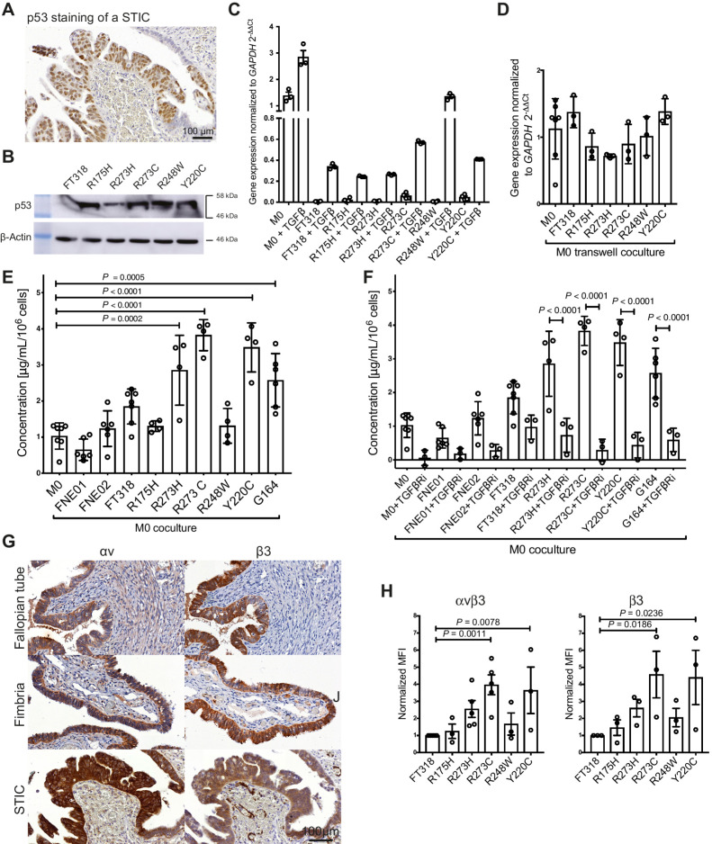 Figure 4. Stimulation of TGFBI expression in macrophages by p53 mutated FTSE cells resembling STICs. A, Expression of p53 in STIC lesions. B, Expression of p53 in FT318 wild-type and mutant p53 transduced FTSE cells (R175H, R273H, R273C, R248W, Y220C). β-actin was used as loading control. C, TGFBI transcript expression of unstimulated and TGFβ-stimulated FT318 wild-type and mutant p53 FTSE cell lines in comparison with unstimulated (unst.) and TGFβ-stimulated macrophages. Data (n = 3) shown are mean ± SEM. Statistical significance was determined using one-way ANOVA with Dunnett multiple comparisons test. D, TGFBI expression in macrophages cultured in transwells with FTSE wild-type and FTSE-mutant cell lines. Data are shown for unstimulated macrophages (n = 7), FT318 (n = 3), R175H (n = 3), R273H (n = 3), R273C (n = 3), R248W (n = 3), and Y220C (n = 3). Statistical significance was determined using one-way ANOVA with Dunnett multiple comparisons test.E, TGFBI secretion of macrophages alone (M0) or cocultured with FTSE cell lines [wild type (FNE01, FNE02, FT318) and mutant p53 (R175H, R273H, R273C, R248W, Y220C)] and a HGSOC cell line (G164) normalized for 106 macrophages. Data are mean ± SD. Macrophages (n = 7), FNE01 (n = 6), FNE02 (n = 6), FT318 (n = 7), R175H (n = 4), R273H (n = 4), R273C (n = 4), R248W (n = 4), Y220C (n = 4), G164 (n = 6). Statistical significance determined using one-way ANOVA with Dunnett multiple comparisons test. Compared with coculture with FT318, secretion of TGFBI is significant only for cell lines R273C and Y220C. F, TGFBI secretion of cocultured macrophages with FTSE and HGSOC cells in the presence or absence of the selective TGFβR inhibitor SB431542. Data are mean ± SD. n = 3 for all the inhibitor-treated conditions. Statistical significance was determined using one-way ANOVA with Dunnett multiple comparisons test. Untreated coculture data points are the same as in E. G, IHC staining of healthy and diseased human tissues for the integrin subunits αv and β3. Representative data are shown for FT (n = 3), FB (n = 3), STICs (n = 7), ovary (n = 3), and HGSOC diseased ovary (n = 4) tissues. H, FT318 wild-type and mutant p53 (R175H, R273H, R273C, R248W, Y220C) FTSE cells stained for the integrin αvβ3 [n = 5 (FT318, R273C, R273H); n = 3 (R175H, R248W, Y220C)] and the subunit β3 (n = 3). Data are mean ± SEM. Statistical significance determined using one-way ANOVA with Bonferroni multiple comparisons test. MFI, mean fluorescence intensity.