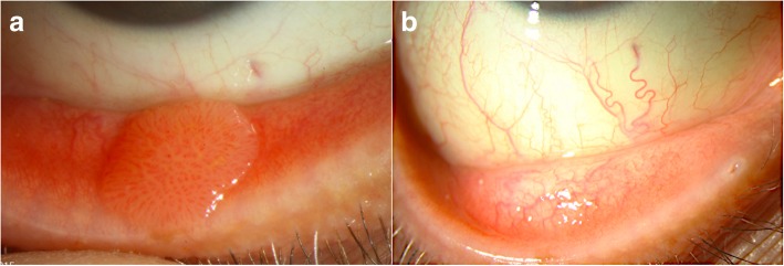 Update on Diagnosis and Management of Conjunctival Papilloma - PMC