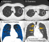 Example case in a 45-year-old man with history of stem cell transplant and
graft-versus-host disease with bronchiolitis obliterans syndrome (BOS) causing
diffuse air trapping. At (A) inspiration and (B) expiration, lung attenuation in
the left upper lobe in the regions of interest (ROIs) were 896 HU and 797 HU,
respectively. (C) On the artificial intelligence–generated quantitative
overlay, there is extensive air trapping throughout the lungs (shown in blue,
with areas of emphysema shown in red). For this case, readers’ assessment
of air trapping increased by nearly one grade between placement of ROIs and
provision of quantitative maps. (D) Two months after the initial CT, the patient
went on to develop spontaneous pneumomediastinum (arrows), a rare complication
of severe BOS.
