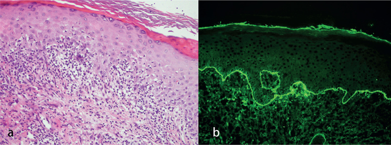 Persistent Widespread Pruritic Nodules: A Quiz - PMC