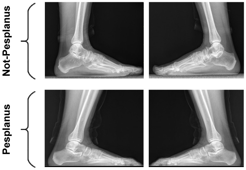 A Novel Deep Transfer Learning-Based Approach for Automated Pes Planus ...